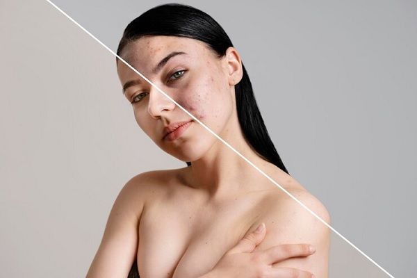 microneedling