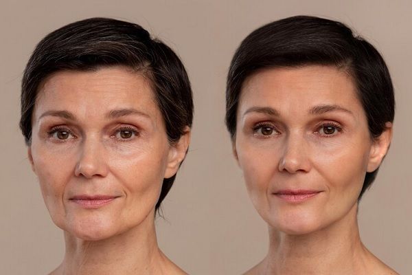 Bótox Madrid - Comparativa del antes y después de la aplicación de bótox Madrid en el rostro de una mujer