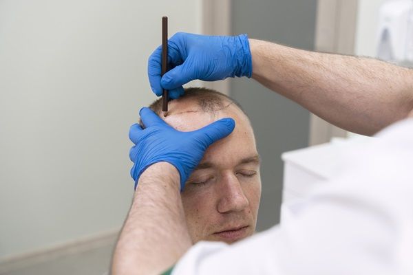 Implante capilar Barcelona - Tricólogo realizando el diseño del injerto capilar Barcelona a un hombre con alopecia en las entradas