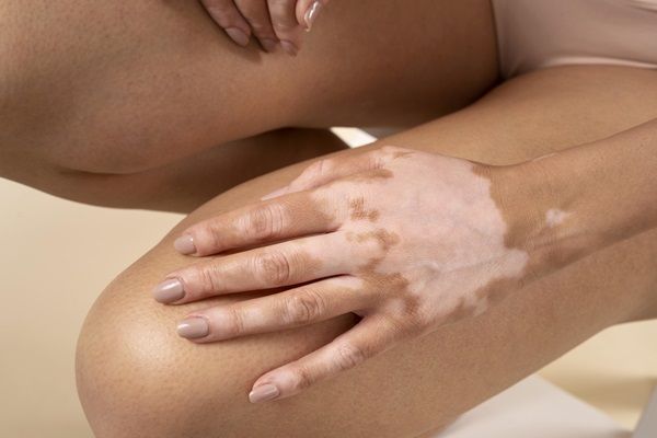 enfermedades cutaneas en mano de mujer