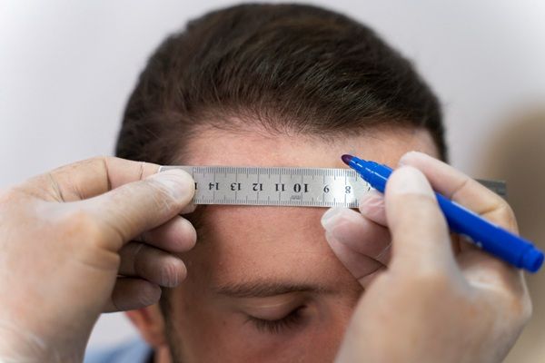 Injerto capilar - Tricólogo evaluando el cuero cabelludo de un hombre con alopecia para determinar el precio injerto capilar Madrid