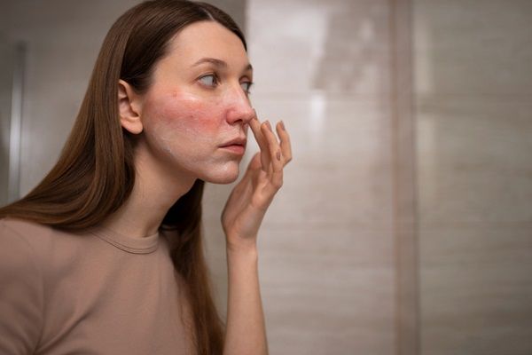 Mujer joven con rosácea en el rostro mirándose al espejo