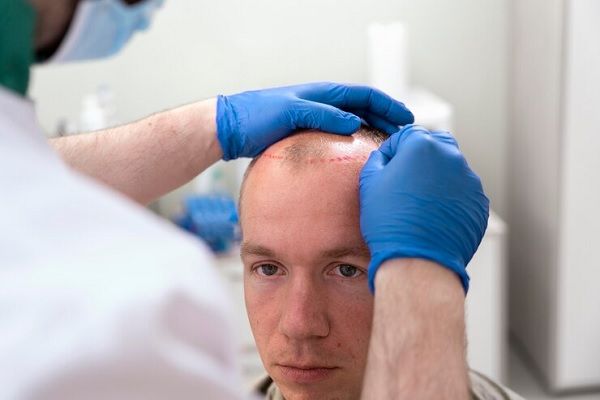 Trasplante capilar Precio - Médico tricólogo realizando el diseño del trasplante capilar Barcelona a un hombre con alopecia en las entradas