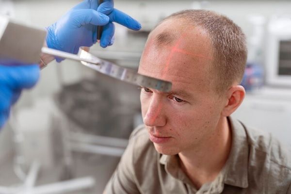 Trasplante capilar Precio - Hombre con alopecia avanzada revisándose para un injerto capilar Barcelona