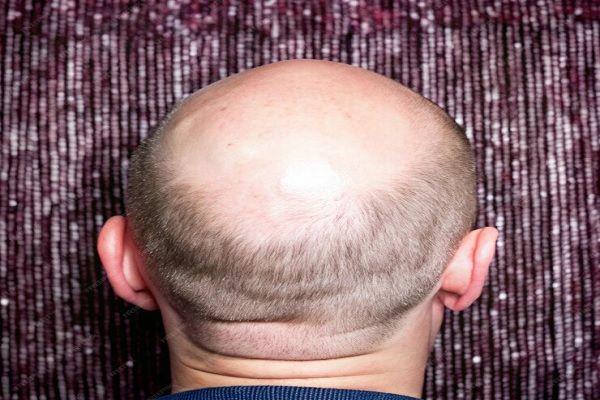 Hombre con alopecia que requiere de trasplante capilar Barcelona