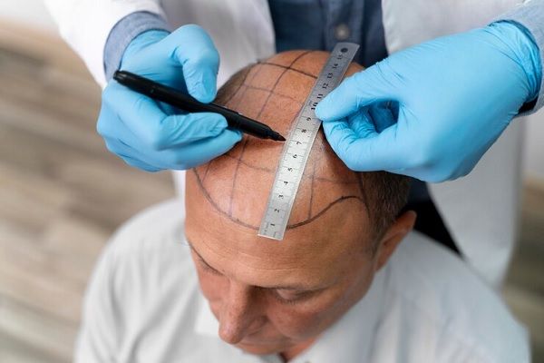 Médico define el diseño para implante capilar a paciente con alopecia avanzada