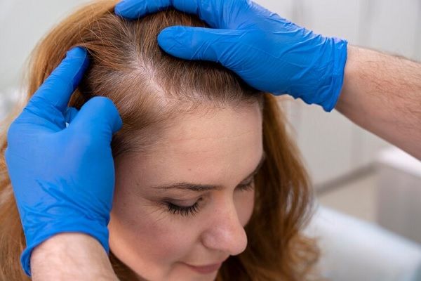Tricologo revisa cuero cabelludo de mujer con pérdida capilar