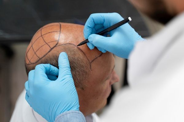 Precio injerto capilar Turquía - Tricólogo realizando el boceto del implante de pelo a un hombre con alopecia avanzada para realizar el trasplante capilar Turquía