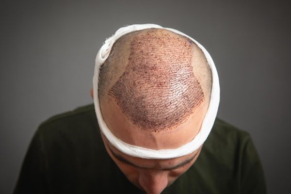 Clínica injerto capilar Turquía - Recuperación del implante capilar Turquía en un hombre con alopecia avanzada realizado en la mejor clínica injerto capilar Turquía