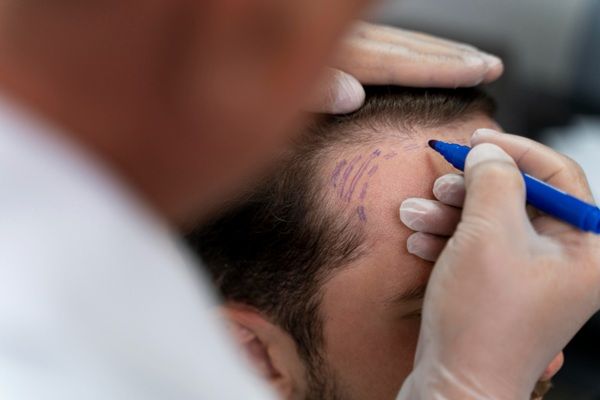 Trasplante capilar Turquía - Tricólogo realizando el boceto del implante capilar Turquía a un hombre con pérdida de cabello en las entradas