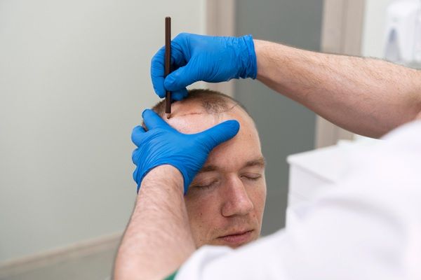 Tricólogo realizando el diseño del implante de cabello a un hombre con alopecia