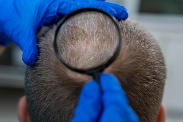 Médico tricólogo evaluando el cuero cabelludo de un hombre con alopecia en la coronilla antes de realizarse un injerto capilar Madrid