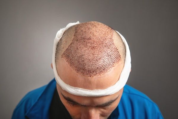 Injertos capilares Madrid - Resultado del trasplante capilar Madrid en un hombre con alopecia en la coronilla realizado en la mejor clínica injerto capilar Madrid