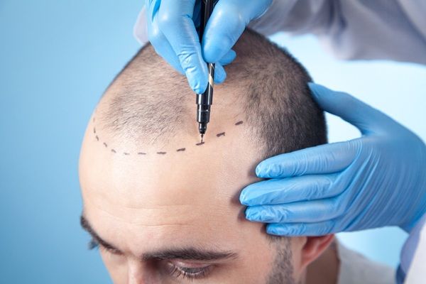 Médico capilar realizando el boceto del trasplante de cabello a un hombre con pérdida de cabello