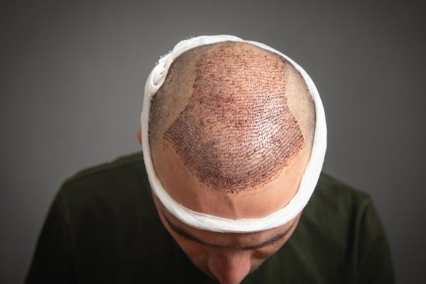 Ventajas injerto Capilar Turquía - Hombre con recuperación del cabello en la coronilla luego de un trasplante capilar Turquía en una de las mejores clínicas injerto capilar Turquía