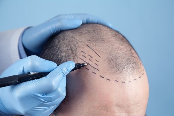 Elegir injerto capilar Turquía - Tricólogo realizando el boceto del injerto capilar Turquía a un hombre con pérdida de cabello en las entradas