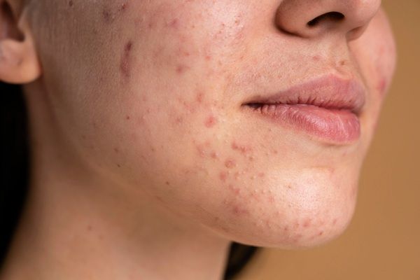 Manchas en la cara - Mujer con manchas de sol en la cara por no usar tratamientos estéticos para eliminar manchas en el rostro