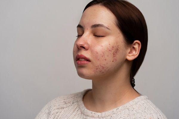 Manchas en la cara - Mujer joven con manchas en la mejilla por no usar la mejor crema para manchas en la cara