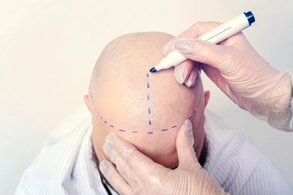 Mejor cirujano capilar España - Médico capilar realizando el boceto del injerto capilar Madrid a un hombre con calvicie avanzada