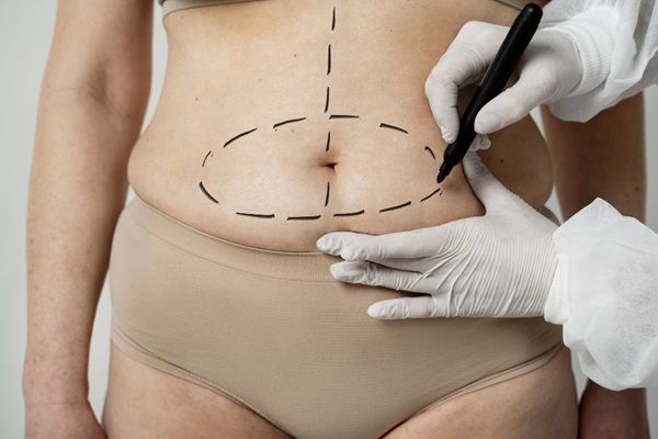 Reducir la grasa - Cirujano estético realizando el boceto a una mujer para adelgazar sin cirugía y reducir la grasa abdominal