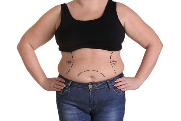 Reducir la grasa - Mujer con grasa localizada en el abdomen y boceto del tratamiento para adelgazar sin cirugía y reducir la grasa abdominal