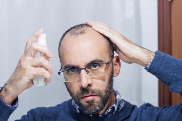 Soluciones a la calvicie - Hombre aplicándose un tratamiento tópico para la alopecia recetado en la mejor clínica injerto capilar Madrid para estimular el crecimiento del cabello