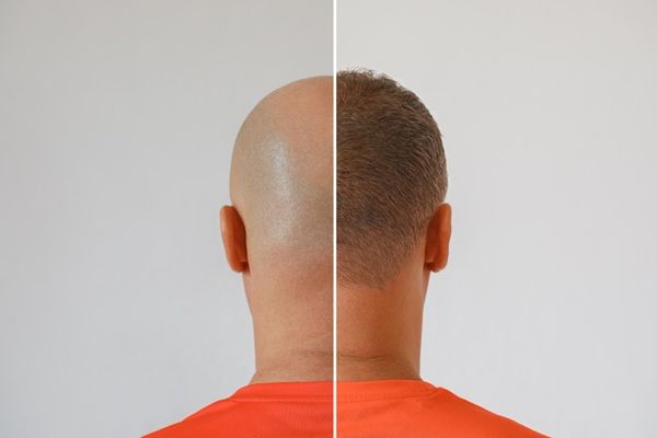 imagen de Implante capilar antes y después