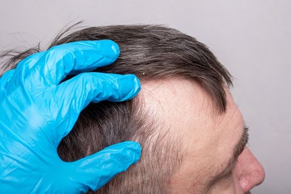Trasplante capilar Barcelona - Tricólogo evaluando la alopecia de un hombre para realizar un trasplante capilar Barcelona en una de las mejores clínicas injerto capilar Barcelona