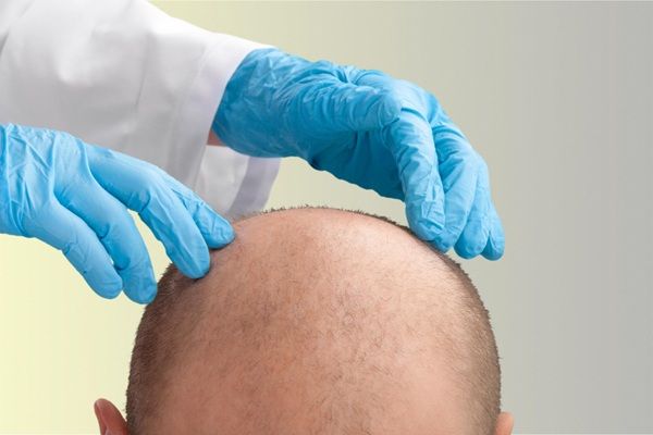 Trasplante capilar Barcelona - Mejor cirujano capilar España evaluando a un hombre con alopecia avanzada en una de las mejores clínicas injerto capilar Barcelona para recuperar el cabello