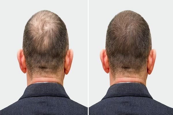 Implante capilar antes y después