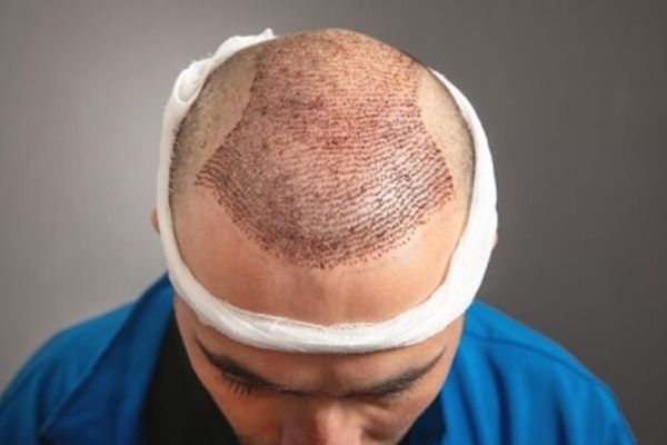 Implante capilar Turquía todo incluido - Resultado del trasplante capilar Turquía en un hombre con pérdida de cabello en la coronilla