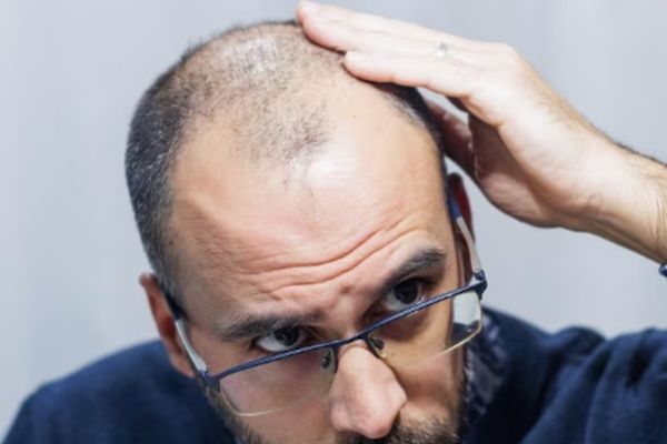 Implante capilar Turquía todo incluido - Hombre con alopecia androgénica tocándose la cabeza antes de un injerto capilar Turquía que permite recuperar el pelo de forma natural