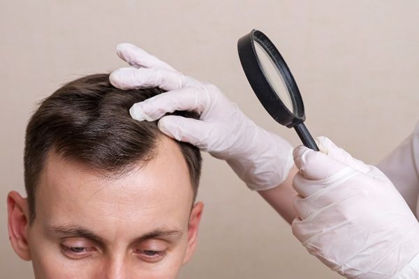 Precio injerto capilar - Hombre joven con pérdida de cabello visitando la mejor clínica injerto capilar Madrid para realizarse un trasplante capilar Madrid