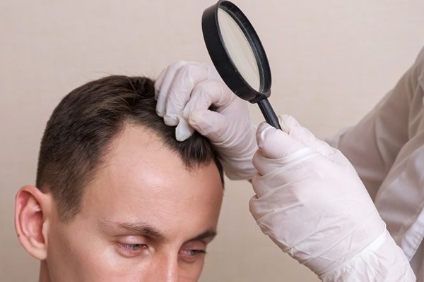 Precio injerto capilar - Uno de los mejores doctores injerto capilar España evaluando el cuero cabelludo de un hombre con alopecia para realizar un injerto capilar Madrid
