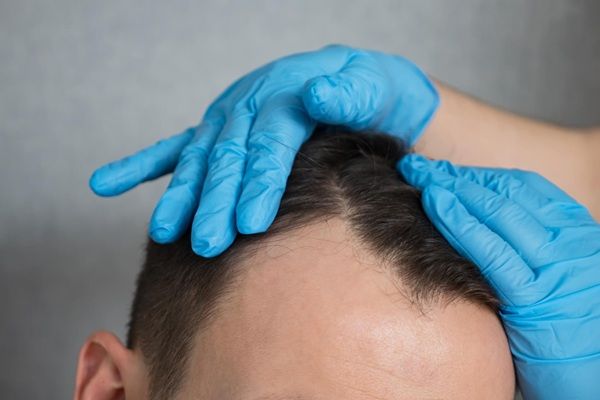 Precio injerto capilar - Mejor cirujano capilar España evaluando la alopecia androgénica de un hombre para realizar un injerto capilar Madrid