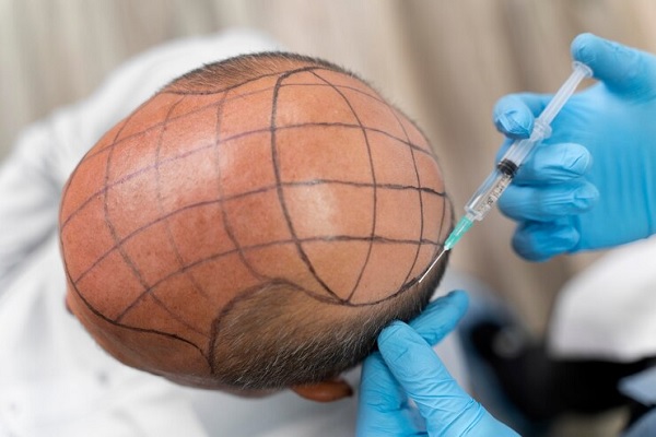 Novedades en injerto capilar Madrid - imagen de paciente con alopecia antes del trasplante capilar Madrid