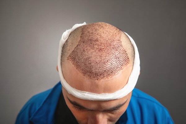 Resultados trasplante capilar Madrid - Resultados del injerto capilar Madrid en un hombre con alopecia en la coronilla