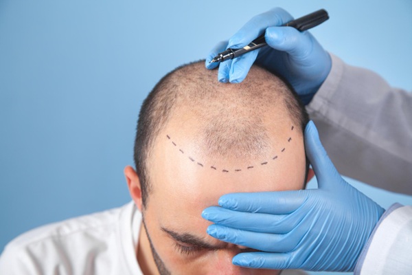 Médico tricólogo realizando el diseño del injerto capilar Madrid a un hombre con alopecia androgénica