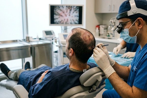 Trasplante capilar Madrid - Tricólogo realizando un implante capilar Madrid a un hombre con alopecia en la coronilla