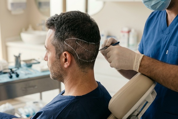 Zona donante - Médico tricólogo realizando la extracción de los folículos para un injerto capilar